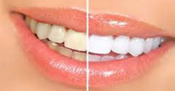 سفید کردن دندان روشی برای جرم گیری دندان در منزل